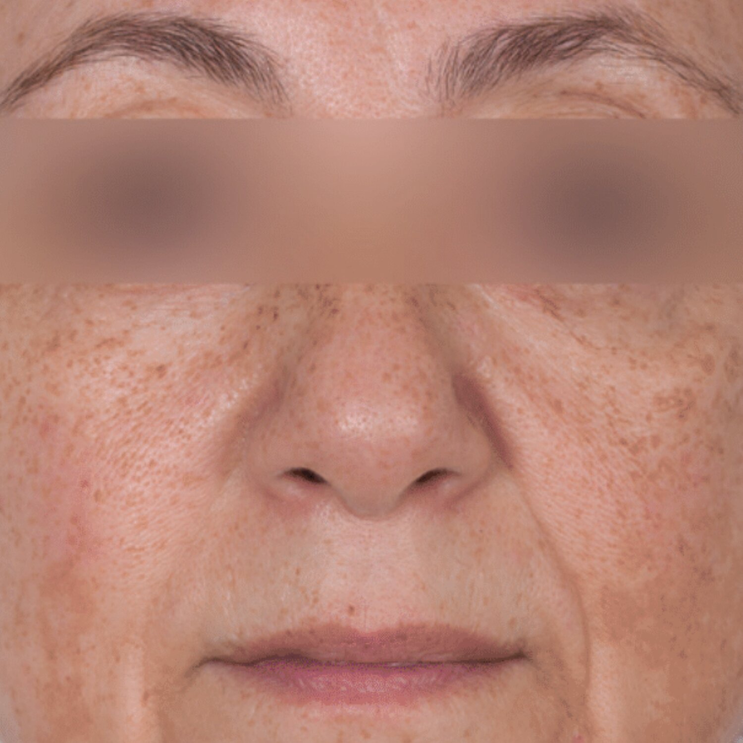 Antes — melasma y discromía facial