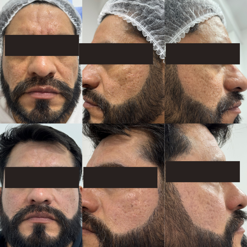 Antes y después — Tratamiento acné