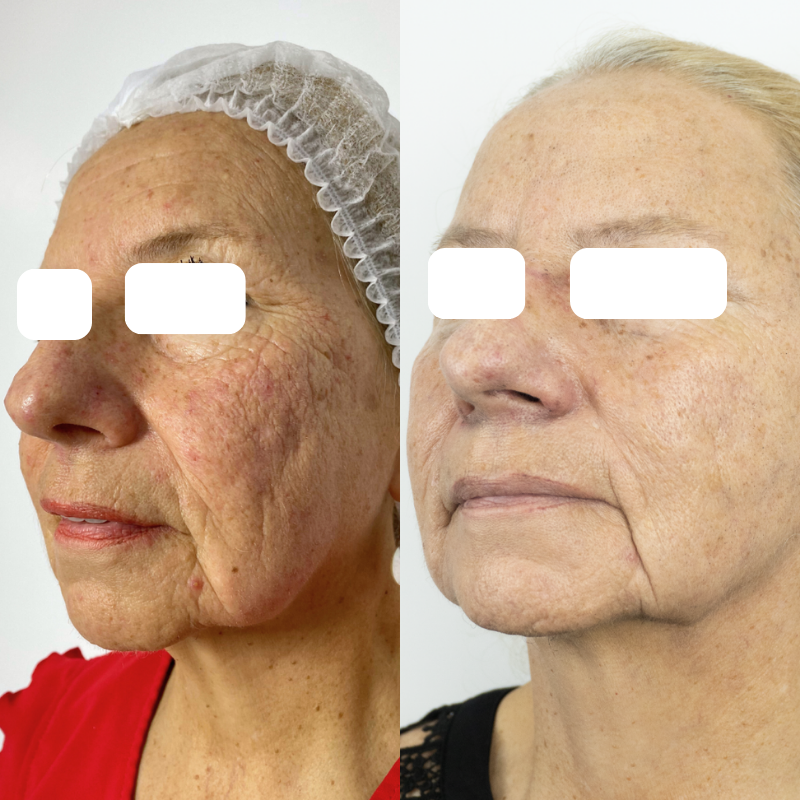 Antes y después — Renovación facial